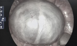 Chủ quan với cơn đau bụng, phát hiện u buồng trứng 14cm