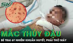Biến chứng thủy đậu, bé trai 6 tuổi nhiễm khuẩn huyết, phải thở máy nguy kịch