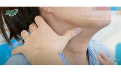 Viêm tuyến giáp mạn tính có làm tăng nguy cơ ung thư tuyến giáp không ?
