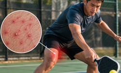 Chơi Pickleball, bóng đá mùa nóng: Nam giới dễ bị nhiễm trùng da