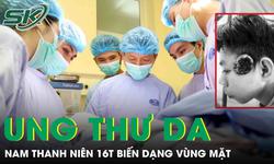 Nam thanh niên 16 tuổi ung thư da vỡ loét, gây biến dạng vùng mặt 