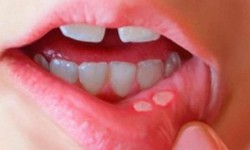 Phân biệt nhiệt miệng và ung thư lưỡi: Cách nhận biết sớm căn bệnh nguy hiểm
