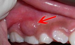 Cảnh báo biến chứng nguy hiểm của áp xe răng