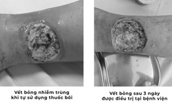 Tự chữa bỏng bằng thuốc dân gian, người đàn ông suýt hoại tử chân