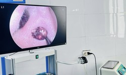 Đau nhức tai suốt một tuần, người phụ nữ tá hỏa vì 'vị khách lạ' trong tai