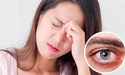Đau hốc mắt cảnh báo bệnh gì?