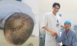 90 phút 'nghẹt thở' cứu người đàn ông bị vỡ lún sọ, tràn máu màng phổi