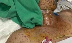 Nam bệnh nhân 32 tuổi bị biến chứng thuỷ đậu phải thở máy kéo dài 