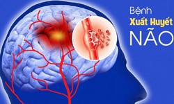 Cảnh báo xuất huyết não sau những cuộc nhậu kéo dài