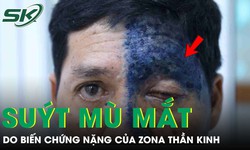 Người đàn ông 54 tuổi suýt mù mắt do biến chứng nặng của zona thần kinh