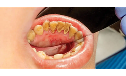 Có cần phải lấy cao răng thường xuyên?