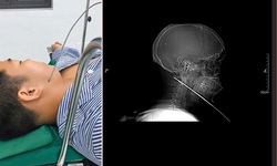 Nam thanh niên đi bắn cá bị mũi tên bật ngược đâm xuyên sâu 15cm vào vùng mặt