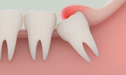 Nhổ răng khôn có nguy hiểm không, khi nào cần nhổ?