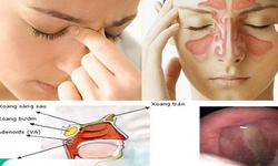 Viêm mũi xoang mùa mưa: Đừng chủ quan với những cơn nghẹt mũi kéo dài