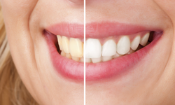 4 hệ luỵ nếu tẩy trắng răng sai cách