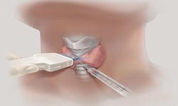 Phát hiện nhân tuyến giáp có nhất thiết phải chọc hút tế bào?