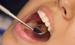 Vi khuẩn thường gặp trong miệng có thể là 'thủ phạm' âm thầm gây hẹp van tim?