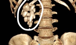 Loại bỏ khối sỏi thận hình dáng như củ gừng cho người phụ nữ