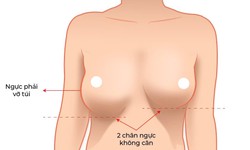 Vì sao xử lý túi ngực bị vỡ và đặt lại túi mới khó hơn nhiều so với nâng ngực lần đầu?