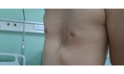 4 dấu hiệu phát hiện lõm ngực bẩm sinh ở trẻ