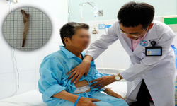 Người đàn ông suýt mất mạng vì mảnh xương đâm thủng dạ dày