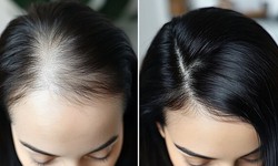 Gội đầu bằng vitamin B1 có nhanh mọc tóc không?