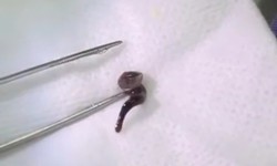 Uống nước ở suối, nam thanh niên bị con đỉa dài 2,5cm chui vào mũi