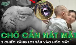 Bé trai 2 tuổi bị chó cắn nát vùng mặt