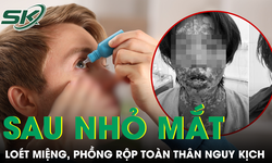 Loét miệng chảy máu, phồng rộp toàn thân nguy kịch sau khi tự dùng thuốc nhỏ mắt