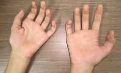 Teo cơ bàn tay ở người trẻ: Cảnh giác với bệnh Hirayama hiếm gặp