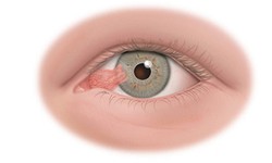 7 dấu hiệu nhận biết xước, rách giác mạc