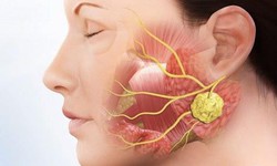Sưng đau vùng mang tai, coi chừng bệnh lý tuyến nước bọt