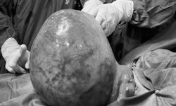 Tưởng tăng cân khi bụng to, người phụ nữ bất ngờ với khối u xơ tử cung nặng 6kg