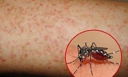 Cô gái tử vong vì sốt xuất huyết, cảnh báo không chủ quan biến chứng bệnh