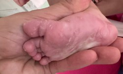 Bé gái 3 tháng tuổi mắc giang mai bẩm sinh