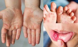Đừng chủ quan với bệnh tay chân miệng: Thấy 6 biểu hiện này cần đi khám sớm