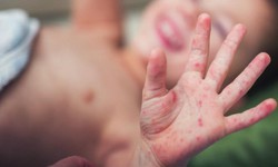 Tay chân miệng gia tăng, cha mẹ cần làm gì để bảo vệ trẻ khỏi nguồn lây?