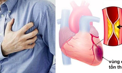 Nhồi máu cơ tim cấp do tắc mạch vành ở người hút thuốc lá nhiều năm