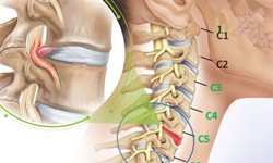 Tê tay khi ngủ chữa thế nào?