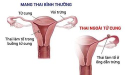 Thử thai 2 vạch, vì sao cần phải đi siêu âm sớm?
