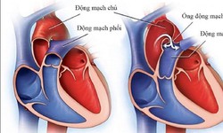 4 dấu hiệu bệnh tim bẩm sinh ở trẻ cha mẹ cần lưu ý