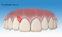 &#193;p xe nha chu – bệnh l&#253; răng miệng nguy hiểm thường gặp