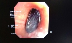 Hạt hồng xi&#234;m trong phổi người phụ nữ gần 1 năm