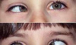 L&#225;c mắt c&#243; chữa được kh&#244;ng?