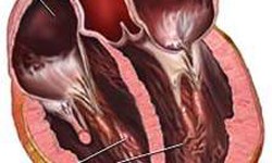 Cơ tim gi&#227;n: Một bệnh l&#253; nguy hiểm