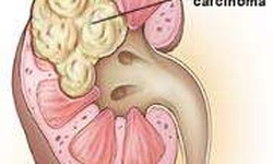 Nước tiểu đỏ l&#224; bệnh g&#236;?