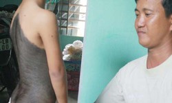 Ch&#225;u b&#233; c&#243; “bộ l&#244;ng da tr&#226;u” khắp người