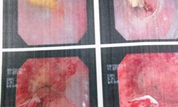 Hóc xương gà, thủng thực quản vì lớn tiếng với con