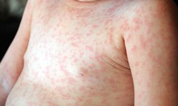 Đ&#227; mắc Rubella c&#243; mắc sởi nữa kh&#244;ng?