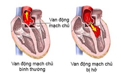 Hở động mạch chủ c&#243; nguy hiểm?